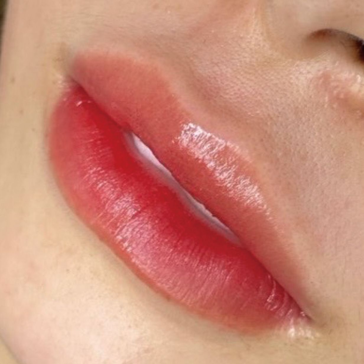 リップ 施術例1