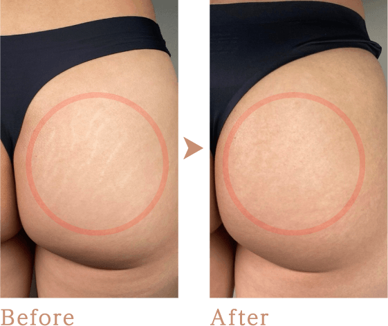 ストレッチマークのBefore After